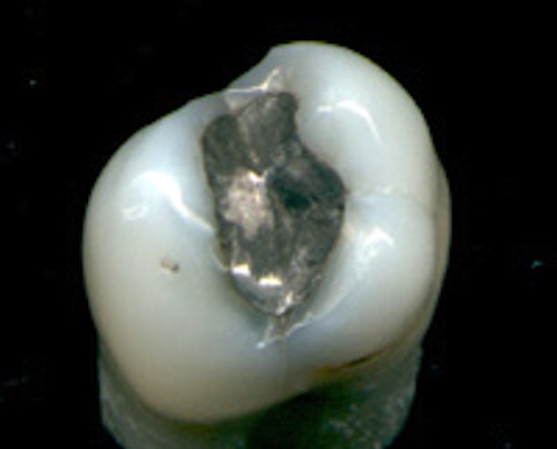 Post image for Mercury Amalgam Fillings: What Dr. Oz Did NOT Tell You