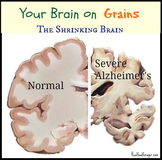 http://realfoodforager.com/wp-content/uploads/2013/09/Alzheimers_brain.jpg