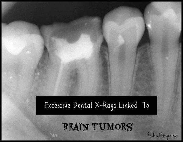 Why I Stopped Getting Routine Dental X-Rays post image