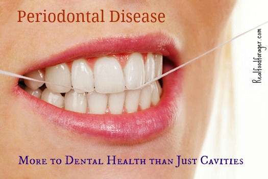 Periodontal Disease: More to Dental Health than Just Cavities post image