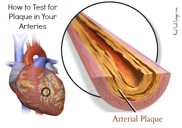 How to Test for Plaque in Your Arteries and What to do If You Have It post image