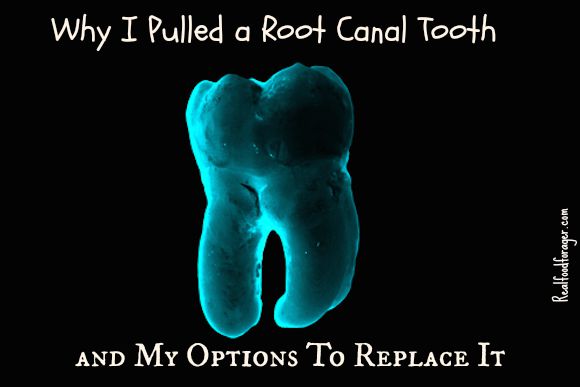 Why I Pulled a Root Canal Tooth and My Options To Replace It post image