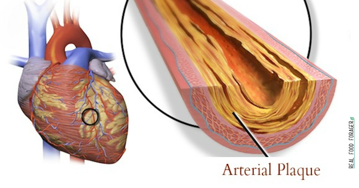 How To Test for Plaque in Your Arteries and WHat To Do If You Have It, Plaque in arteries