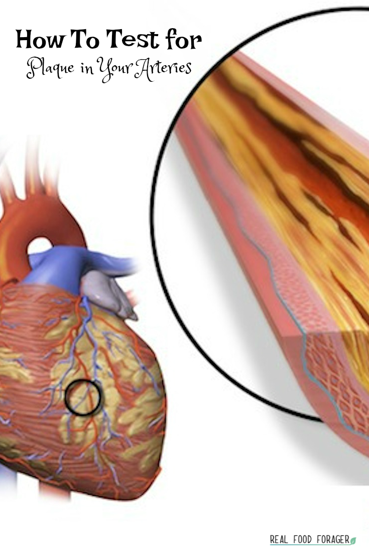 How To Test for Plaque in Your Arteries and WHat To Do If You Have It, Plaque in arteries