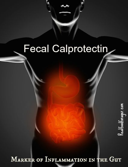 Fecal Calprotectin: Marker of Inflammation in the Gut post image