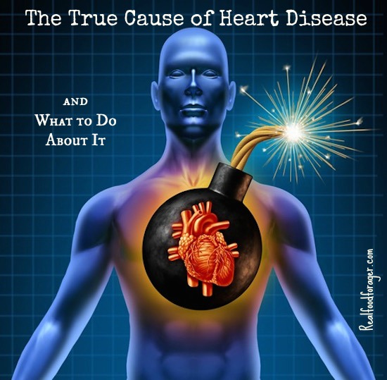 The True Cause of Heart Disease and What to Do About It post image
