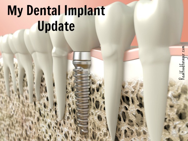 My Dental Implant Update post image