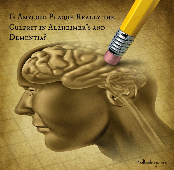 Is Amyloid Plaque Really the Culprit in Alzheimer’s and Dementia? post image