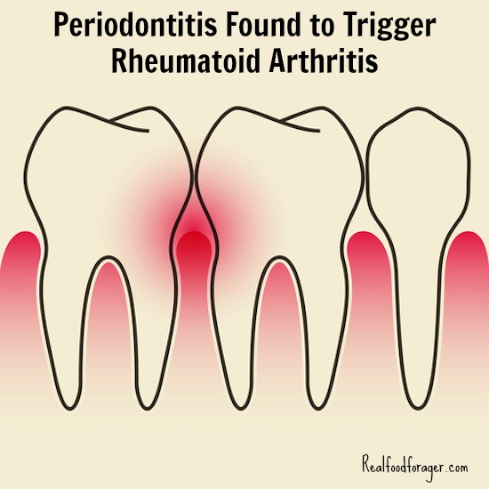 Periodontitis Found to Trigger Rheumatoid Arthritis post image